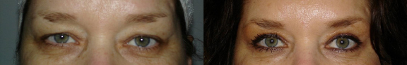 Blepharoplasty before and after photo by Dr. Hamza in London