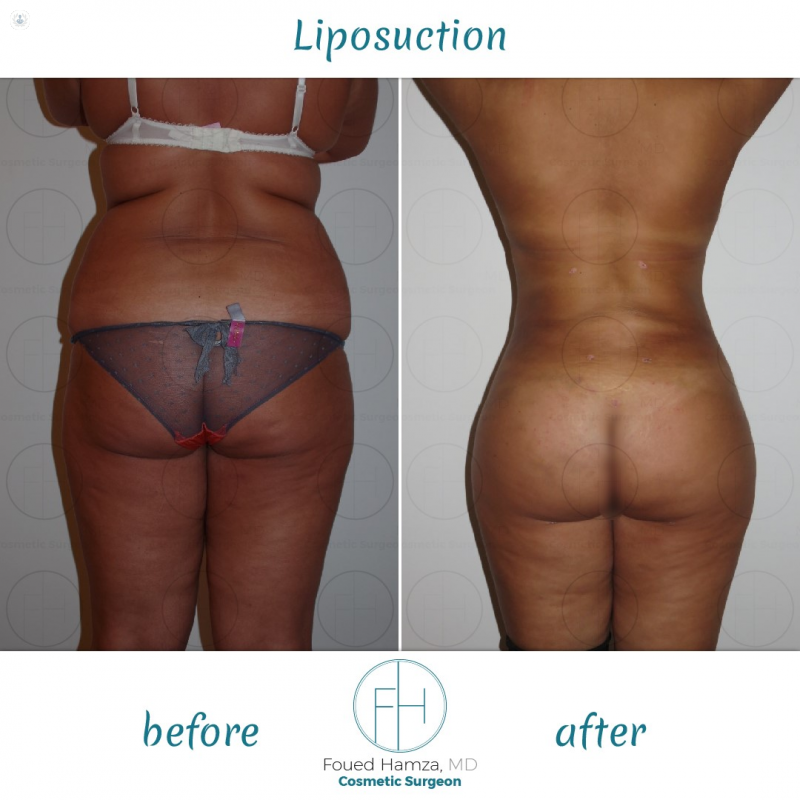 This is an example of a liposuction procedure I performed on a patient that involved the removal of fat and tightening of the skin.