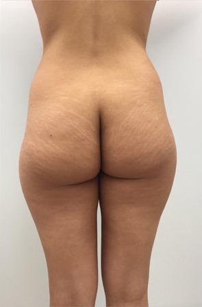 3D Liposuction Before photo by Dr. Foued Hamza in London