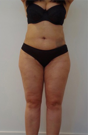 3D Liposuction After photo by Dr. Foued Hamza in London