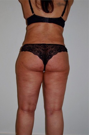 3D Liposuction After photo by Dr. Foued Hamza in London
