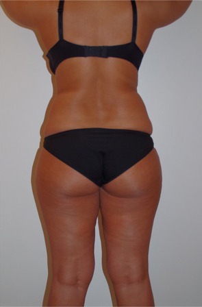 3D Liposuction Before photo by Dr. Foued Hamza in London