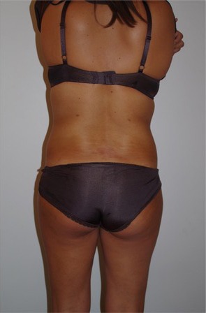 3D Liposuction After photo by Dr. Foued Hamza in London