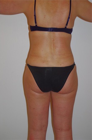 3D Liposuction After photo by Dr. Foued Hamza in London