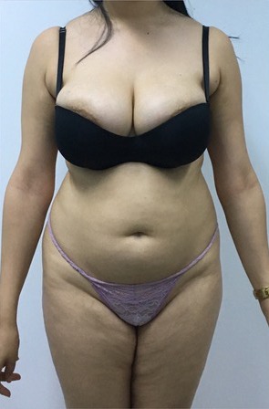 3D Liposuction Before photo by Dr. Foued Hamza in London