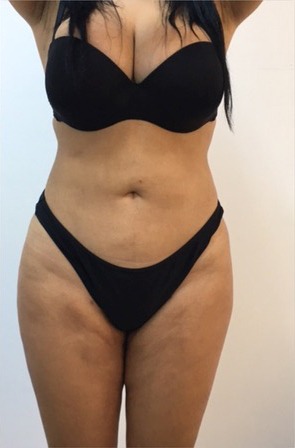 3D Liposuction After photo by Dr. Foued Hamza in London