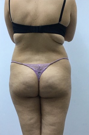 3D Liposuction Before photo by Dr. Foued Hamza in London