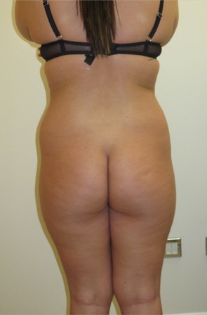 Brazilian Butt Lift Before photo by Dr. Foued Hamza in London