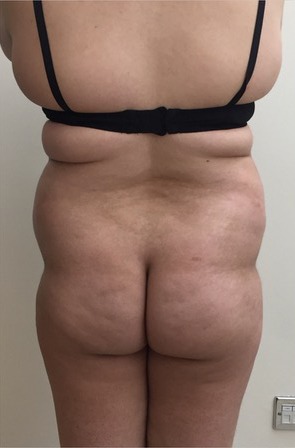 Brazilian Butt Lift Before photo by Dr. Foued Hamza in London