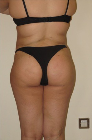 Brazilian Butt Lift After photo by Dr. Foued Hamza in London