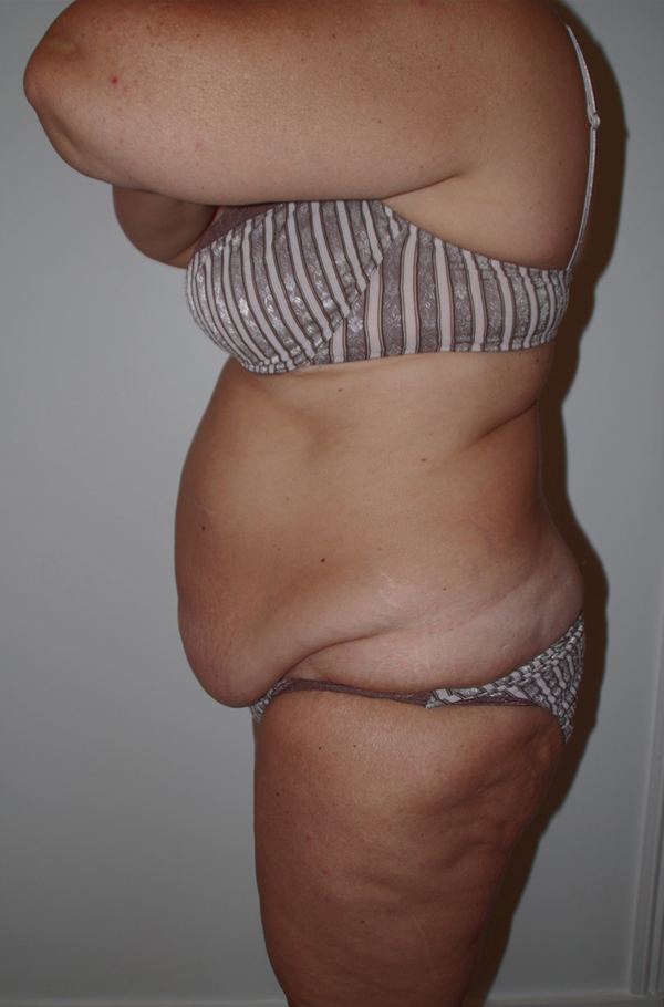 Tummy Tuck Before photo by Dr. Foued Hamza in London