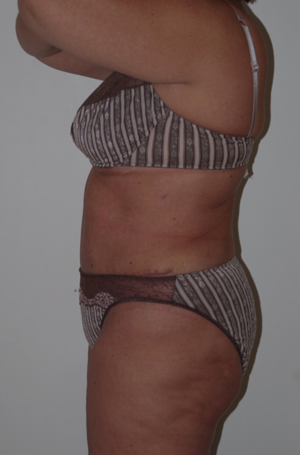 Tummy Tuck After photo by Dr. Foued Hamza in London