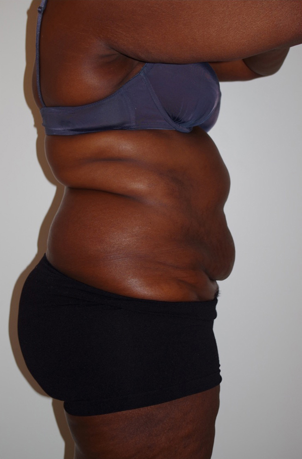 Tummy Tuck Before photo by Dr. Foued Hamza in London