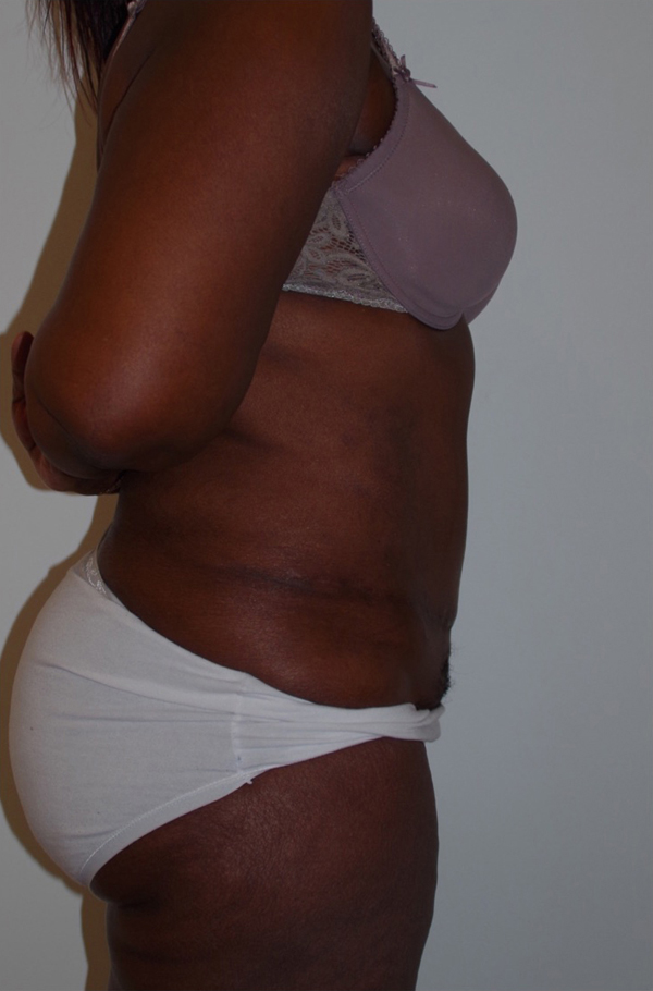 Tummy Tuck After photo by Dr. Foued Hamza in London