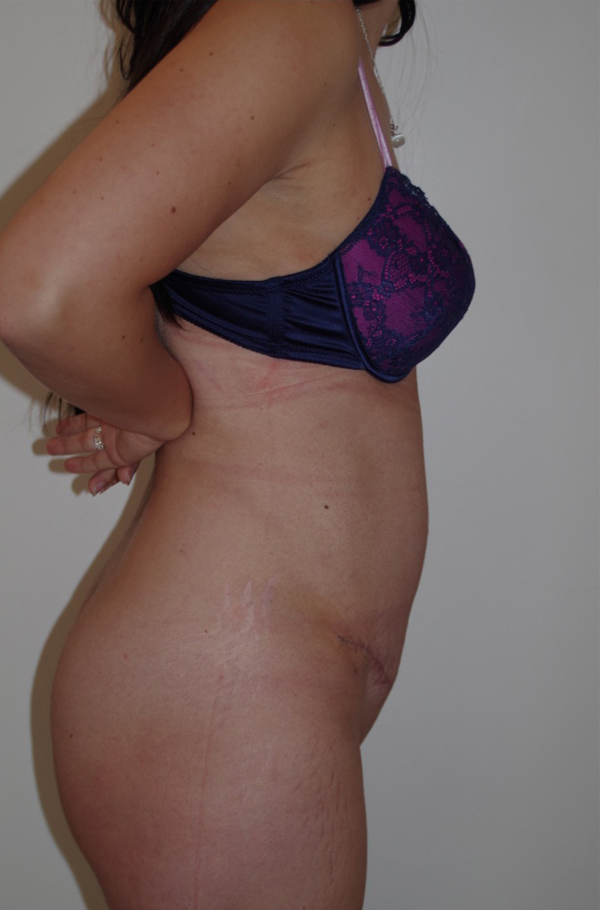 Tummy Tuck After photo by Dr. Foued Hamza in London