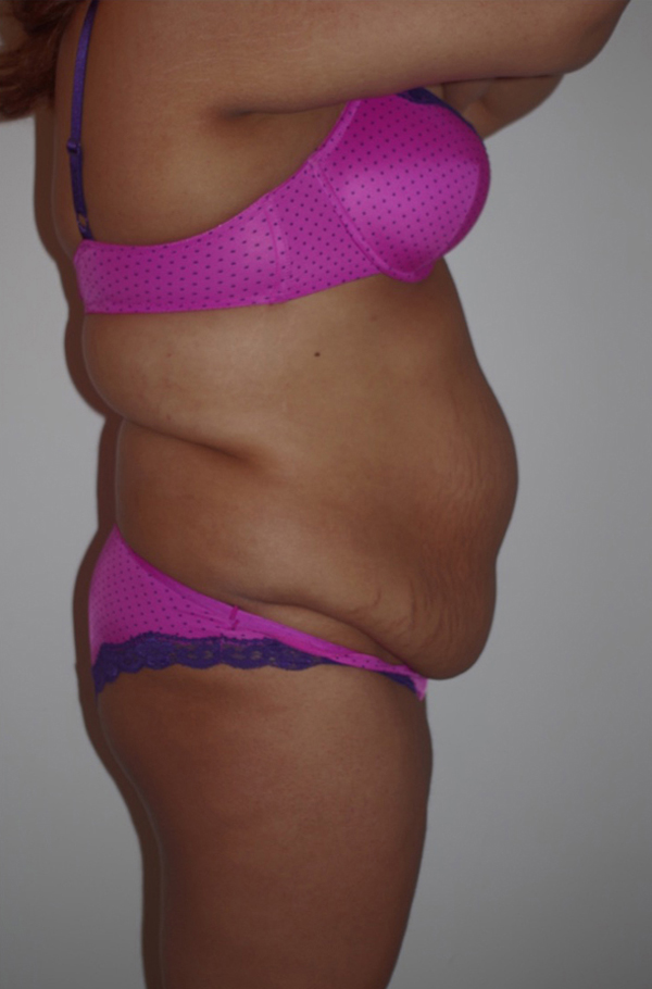 Tummy Tuck Before photo by Dr. Foued Hamza in London