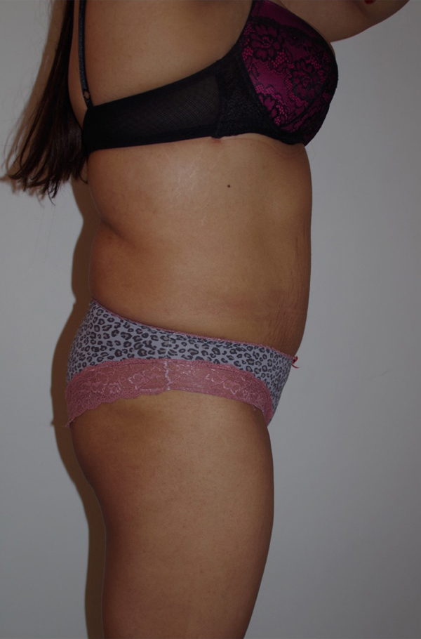 Tummy Tuck After photo by Dr. Foued Hamza in London