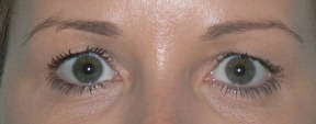 Blepharoplasty Before photo by Dr. Foued Hamza in London