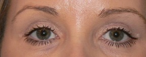 Blepharoplasty After photo by Dr. Foued Hamza in London