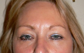 Blepharoplasty before photo by Dr. Hamza in London Blepharoplasty before photo by Dr. Hamza in London