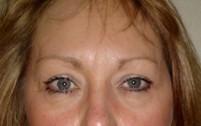 Blepharoplasty after photo by Dr. Hamza in London