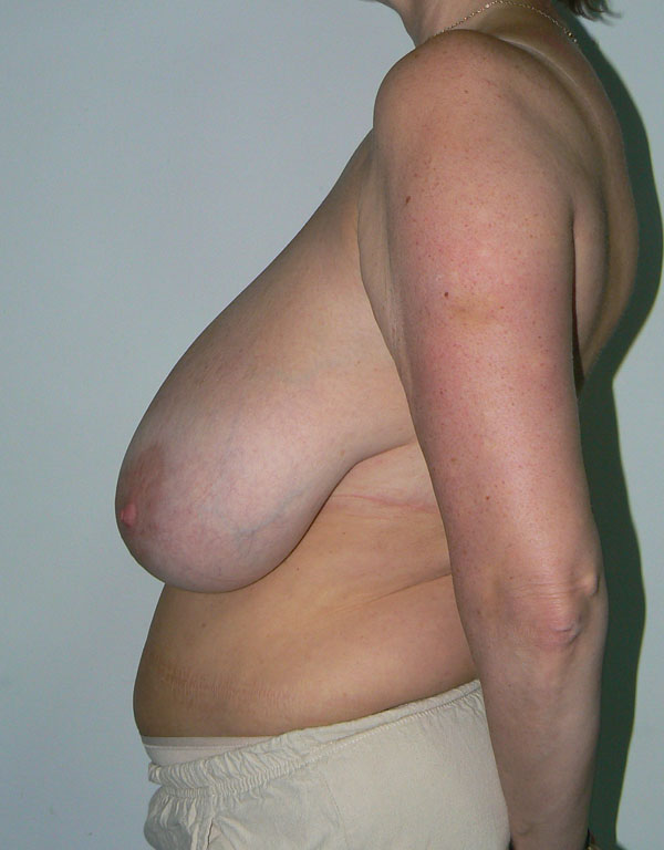 Breast UpLift & Reduction Before photo by Dr. Foued Hamza in London