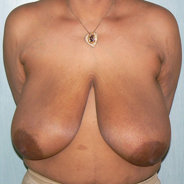 Breast UpLift & Reduction Before photo by Dr. Foued Hamza in London