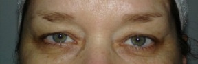 Blepharoplasty Before photo by Dr. Foued Hamza in London