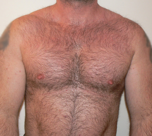Pectoral Implants Before photo by Dr. Foued Hamza in London