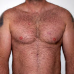 Pectoral Implants After photo by Dr. Foued Hamza in London