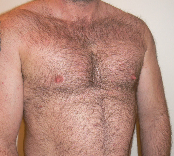 Pectoral Implants Before photo by Dr. Foued Hamza in London
