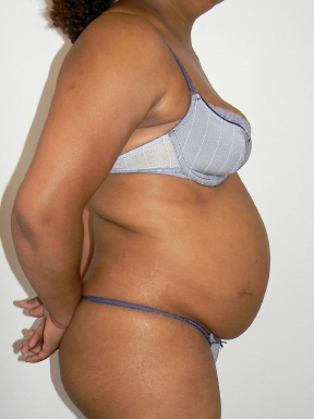 Tummy Tuck Before photo by Dr. Foued Hamza in London