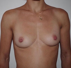 Breast Fat Augmentation Before photo by Dr. Foued Hamza in London