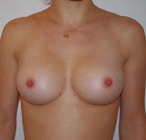 Breast Fat Augmentation After photo by Dr. Foued Hamza in London