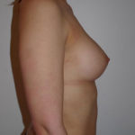 Breast Fat Augmentation After photo by Dr. Foued Hamza in London