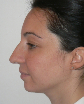 Rhinoplasty Before photo by Dr. Foued Hamza in London