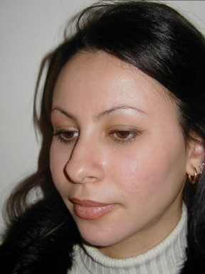 Rhinoplasty Before photo by Dr. Foued Hamza in London