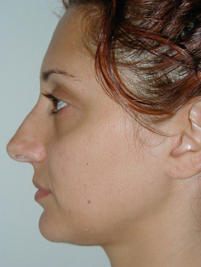Rhinoplasty Before photo by Dr. Foued Hamza in London