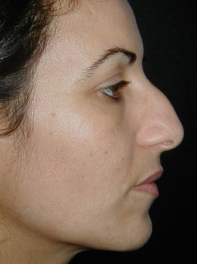 Rhinoplasty before photo by Dr. Hamza in London Rhinoplasty before photo by Dr. Hamza in London