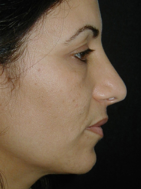 Rhinoplasty after photo by Dr. Hamza in London Rhinoplasty after photo by Dr. Hamza in London