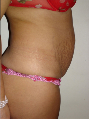 Tummy Tuck before photo by Dr. Hamza in London