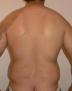Male Liposuction Before photo by Dr. Foued Hamza in London