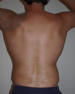 Male Liposuction After photo by Dr. Foued Hamza in London