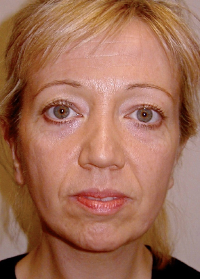Facelift Before photo by Dr. Foued Hamza in London