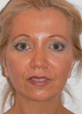 Facelift After photo by Dr. Foued Hamza in London