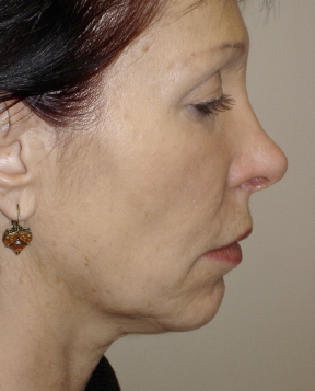 Facelift Before photo by Dr. Hamza in London