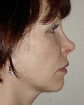 Facelift After photo by Dr. Hamza in London