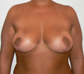 Breast Uplift and Reduction After Photo by Dr. Hamza in London