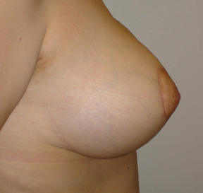 Breast UpLift & Reduction After photo by Dr. Foued Hamza in London