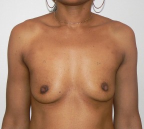 Breast Implants Before photo by Dr. Foued Hamza in London